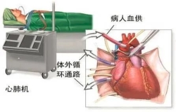 心外科團隊中，體外循環那些事