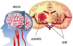 原來高血壓和腦出血有這樣的關系......高血壓別不當回事，警惕變成腦出血！