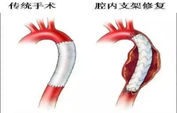 《問心》熱播！全網熱議的主動脈夾層，您了解嗎？