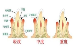 “心口”相依|牙周炎竟與全身這么多疾病有關......